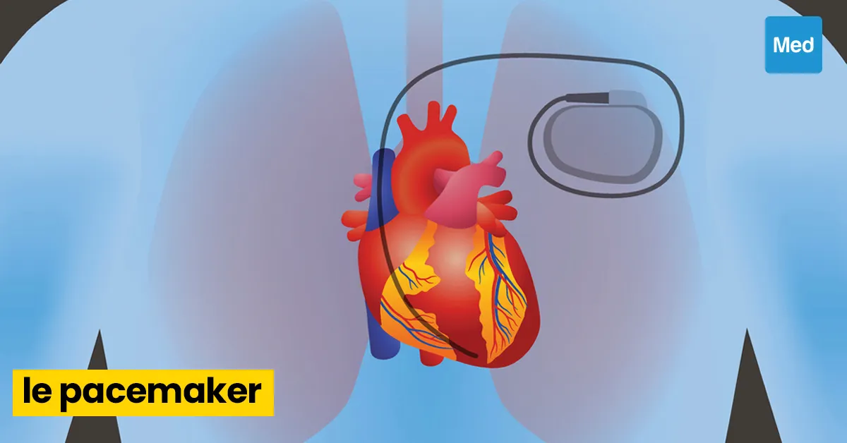 Qu'est-ce qu'un Pacemaker ?
